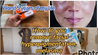 How do you lighten your hyperpigmentation , melasma, freckles | Hyperpigmentation treatment