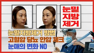 눈밑지방제거수술  전후 사진  고혈압 당뇨 안압 사전 체크 다크서클 개선 아이라인의 변화가 없습니다.