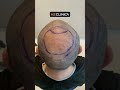 Hair Transplant in Istanbul at H2 Clinica