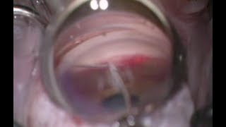 Gonioscopy-Assisted Transluminal Trabeculotomy (GATT) Troubleshooting Tips \u0026 Pearls