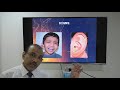 Acute otitis externa (Hindi) Patient teaching programme