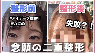 【整形しました。】2児ママ主婦二重整形のダウンタイム大公開