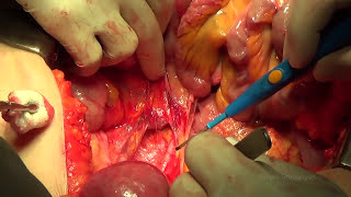 The Type C1 Radical Hysterectomy With Elements Of Total Mesometrial Resection