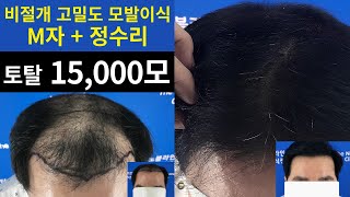 [노블라인 대량모발이식전후] 6176모낭 (15000모) 탈모약 6년 복용 후 1차+2차 모발이식 진행한 남성 케이스