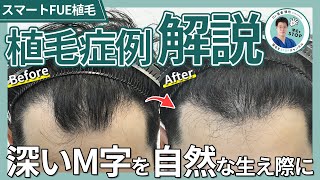 【植毛症例解説】深く後退したM字を高密度で自然な生え際に