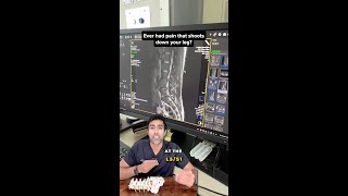 The Real Cause Behind Most Sciatica Pain
