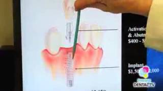 Denver Lowry dentist on dental implants to replace teeth