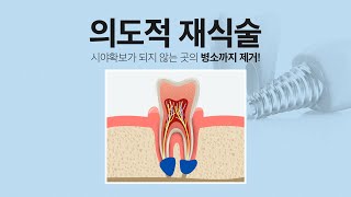 자연치아살리기, 의도적 재식술이란? | 송파구 석촌 베스필치과