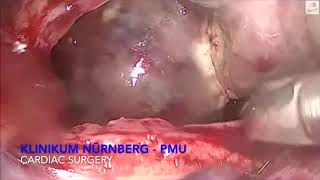 Asvide: Intraoperative record showing removal of the giant myxoma from the opening of pericardium...