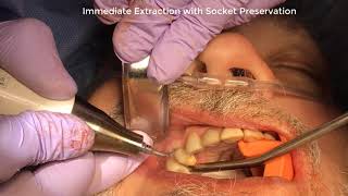 Piezotome CUBE Extraction with Dr Jeffrey Brooks DMD