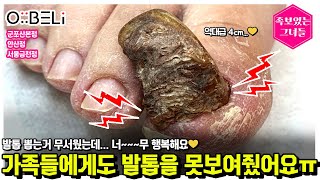 가족들에게도 발톱을 못보여줬어요...😅😅 발톱 뽑는 거 무서웠는데... 너무 행복해요💛 #내성발톱 #무좀발톱 #toenails #ingrown_toenail #발톱 #시원