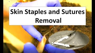 How To Remove Skin Staples and Sutures