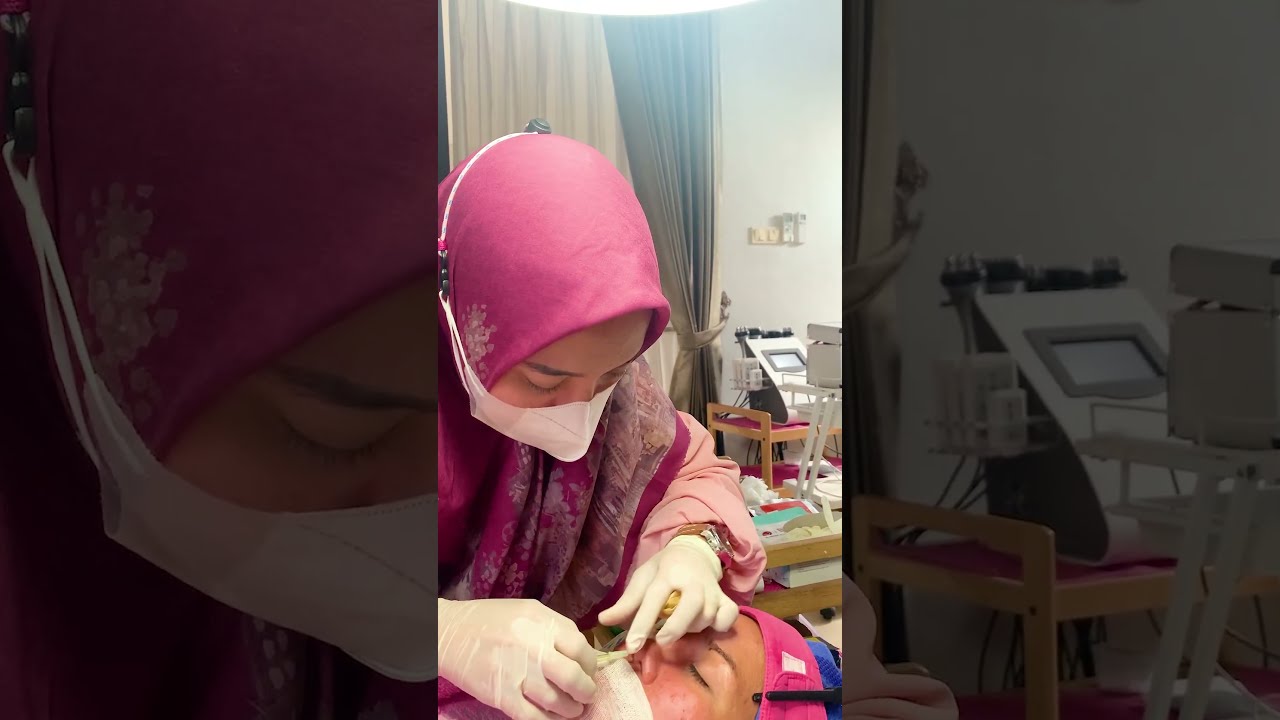 TREATMENT TANAM BENANG HIDUNG RAHMIE CLINIC & BEAUTY - YouTube