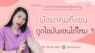 ฝังยาคุม ดูดไขมันแขนได้ไหม ? - หมอหลิว ต้นหลิวคลินิก รามอินทรา