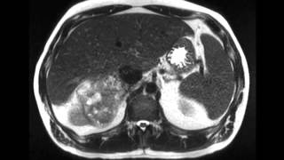 Renal cell carcinoma with renal vein and IVC invasion