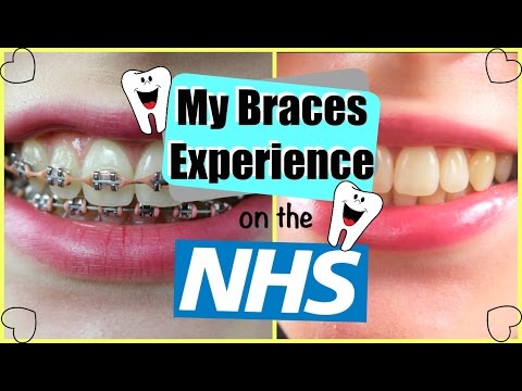 My Braces Experience on the NHS My Braces Experience on the NHS