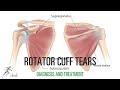 Rotator cuff tear: Signs and symptoms, diagnosis and treatment options for these shoulder injuries