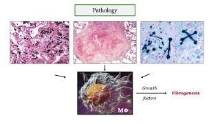 12DaysinMarch, Pneumoconioses for the USMLE Step One Exam