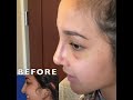 Rhinoplasty Cast Removal - New Nose Reveal