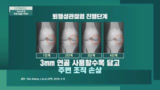 연골이 마모된다? '퇴행성 관절염' 진행 단계 알기! | 다큐 플러스 272회 | JTBC 230813 방송