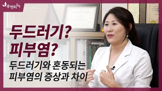 두드러기로 혼동하기 쉬운 접촉성피부염, 스테로이드는 조심!