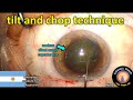 resident cataract surgery: improve your tilt and chop technique