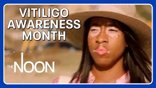 Vitiligo Awareness Month | The Noon