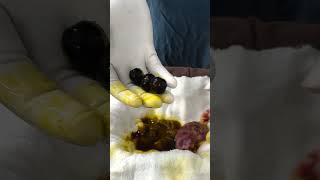 পিত্তথলিতে বড় বড় পাথর | Gallstones | Lapchole