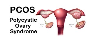 Mayo Clinic Minute - Endometrial cancer associated with PCOS