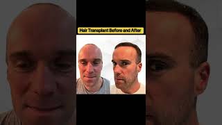 Hair Transplant Before and After | Hair Transplant Result | Hair Transplant inn Turkey