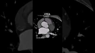 ECG gated computed tomography coronary artery #anatomy #coronaryangiography #ctca #ct