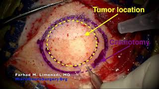 Brain Tumor Resection: Frontal craniotomy and resection of tumor using minimal invasive principles.