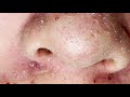 suri job 530 awesome blackheads on nose