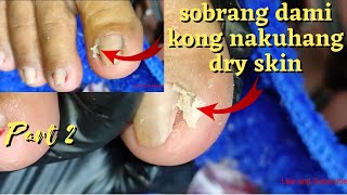 Vlog 541|Dry Skin/Ingrown Removal| PEDICURE 441