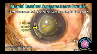 CataractCoach™ 1927: should resident surgeons learn femto-second laser cataract surgery?