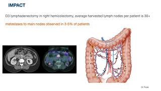 CME CVL D3 LYMPHADENECTOMY VIDEO PRESENTATION AT ACRSICON 2020