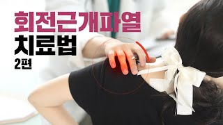 [평촌서울나우병원] 회전근개파열 치료법 - 2편 -