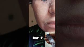 1Month Of Retino-A  Tretinoin cream change my face #drugstore #rewiew #shorts