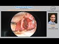 dacryology webinar part 2 recording lacrimal sac diverticula