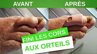 Soigner les cors aux orteils grâce aux ORTHOPLASTIES