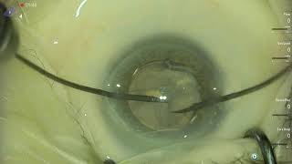 Phimosis rhexis management Lukan Mishev Vista Live Stream