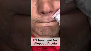 ILS treatment for alopecia areata | Alopecia Areata Beard Treatment | Skinaa Cli