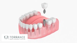 Torrance CA Single Dental Implant and Crown Posterior | Redondo Beach Tooth Implant