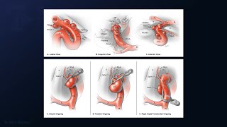 Clipping of a Superior Hypophyseal Artery Aneurysm