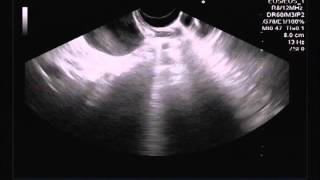 ENDOSONOGRAFIA EN LESION GASTRICO ANTRAL REPRODUCIDA