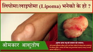 शरीरमा पैदा हुने एकप्रकारको गाँठो लिपोमा (लाइपोमा) (Lipoma)_ओमकार आशुतोष [Omkar Aashutosh}