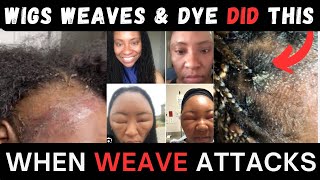 D⚠️NGER: The DARK Side of Wig, Weaves, Dyes & Glue Allergic Reactions