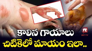 Telugu Health Tips : కాలిన గాయాలు చిటికెలో మాయం ఇలా - Skin Burn Tips In Telugu  @HITTVOFFICIAL