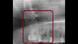 Upper second molar extraction