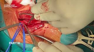 Dr Srdjan Babic Part III Internal Carotid Artery reimplantation after CEA